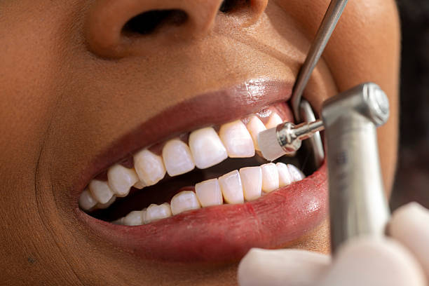 Teeth Cleaning service at Himalaya Dental House