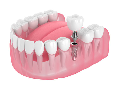 Dental Implants service at Himalaya Dental House