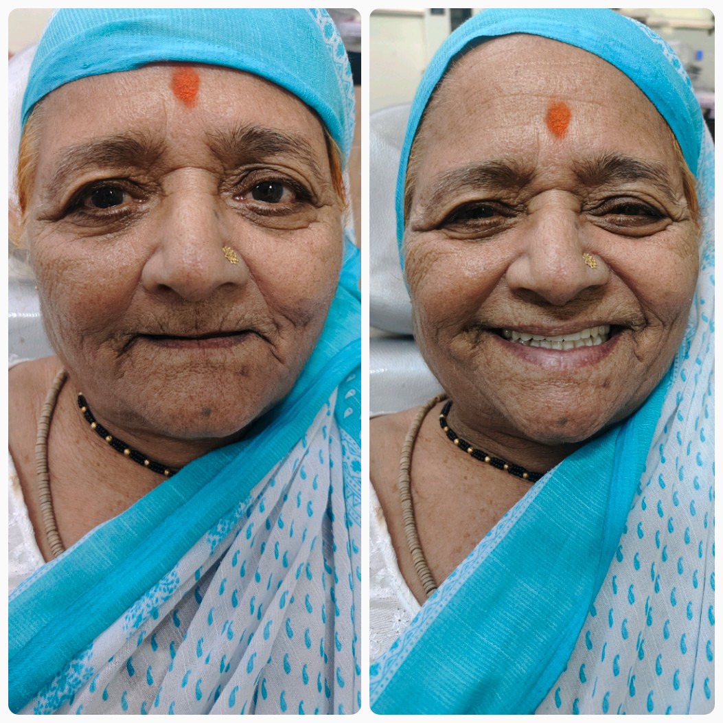 Smile rejuvenation before and after