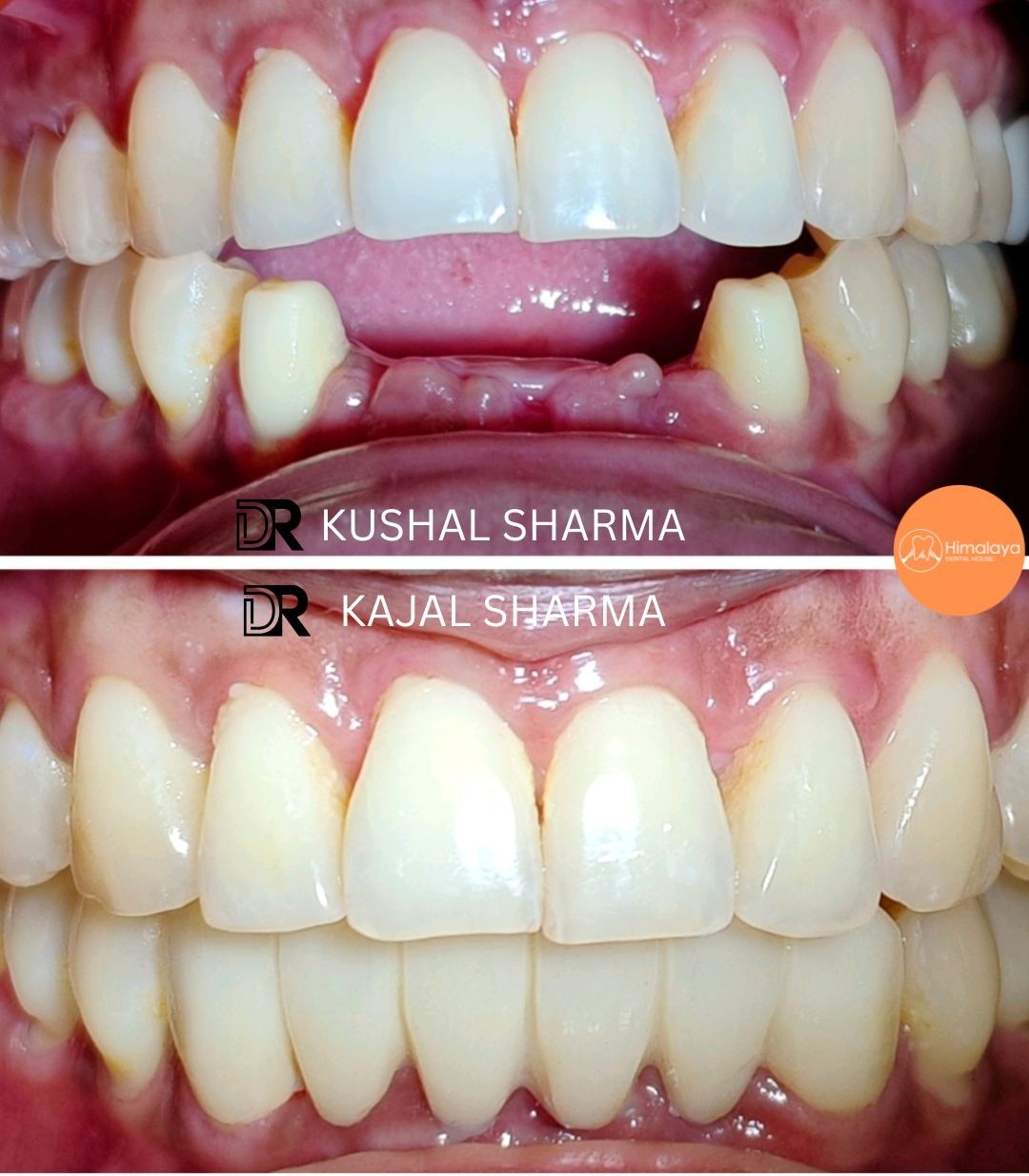 Dental implant X-ray transformation