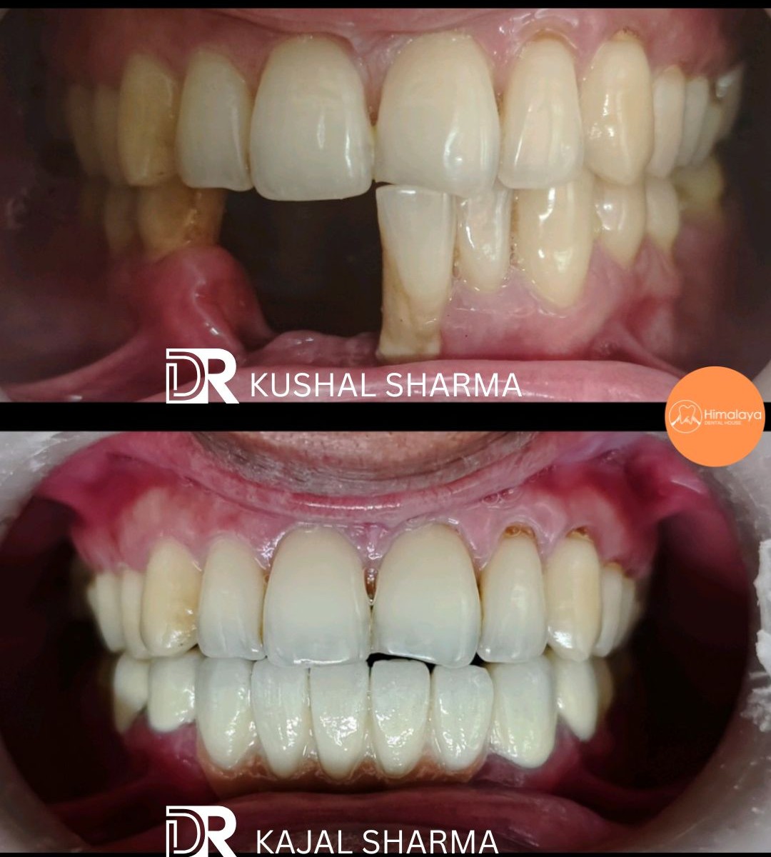 Cavity filling before and after