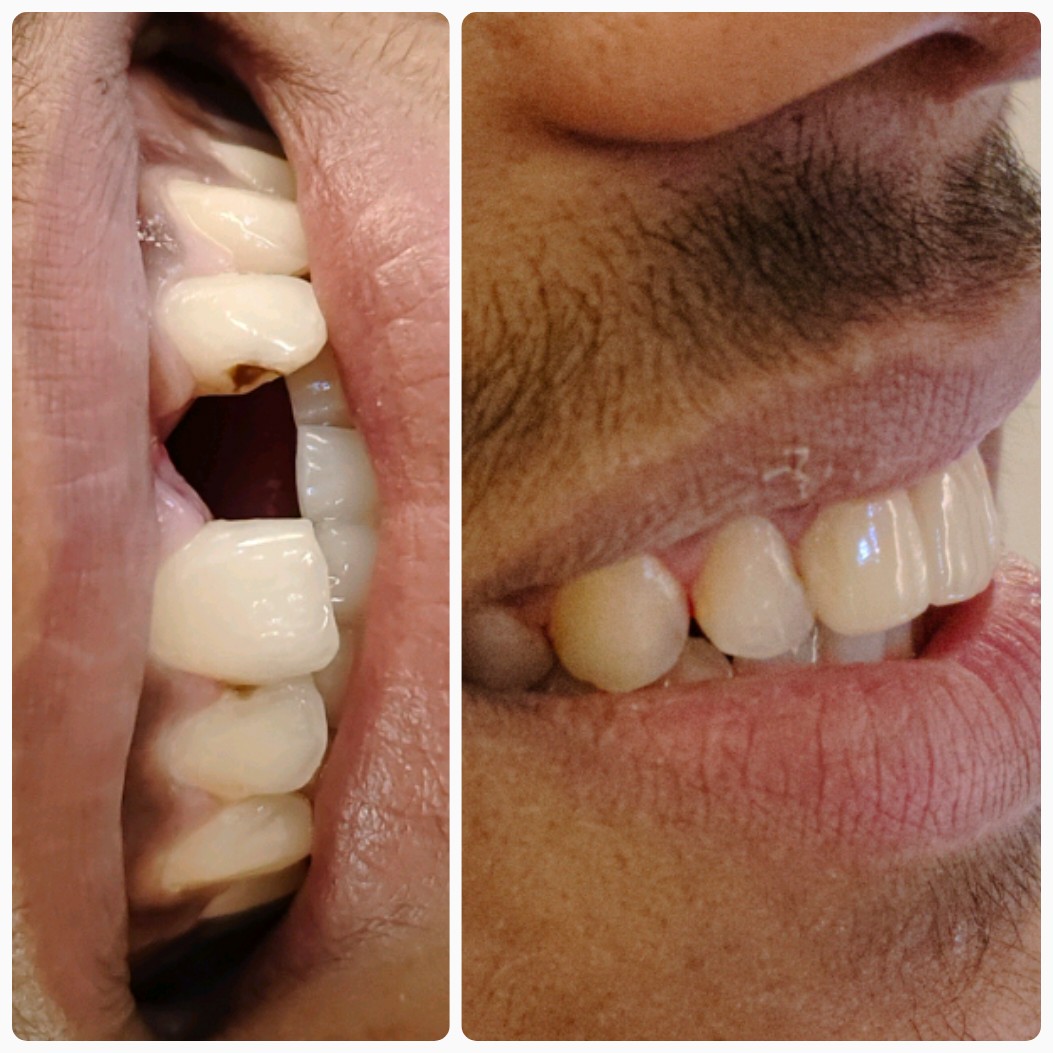 Missing tooth restoration before and after