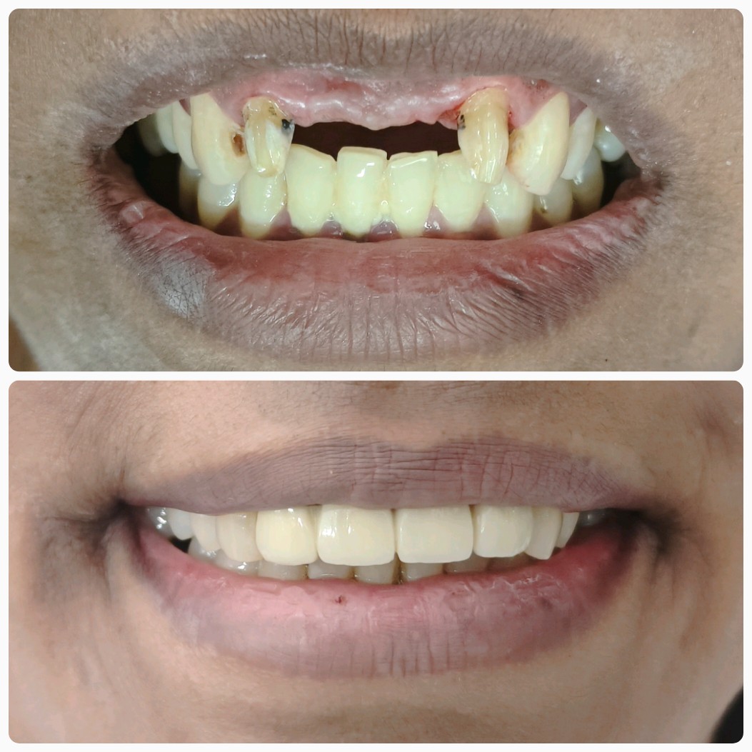 Full mouth rehabilitation before and after