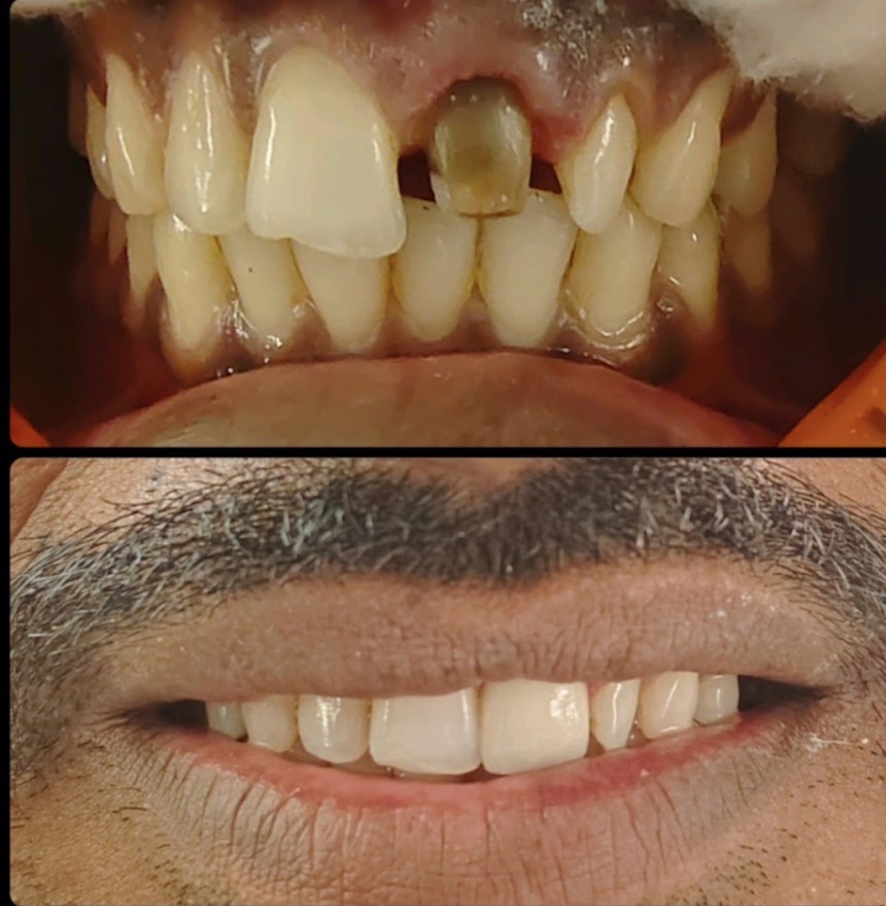 Front tooth implant transformation
