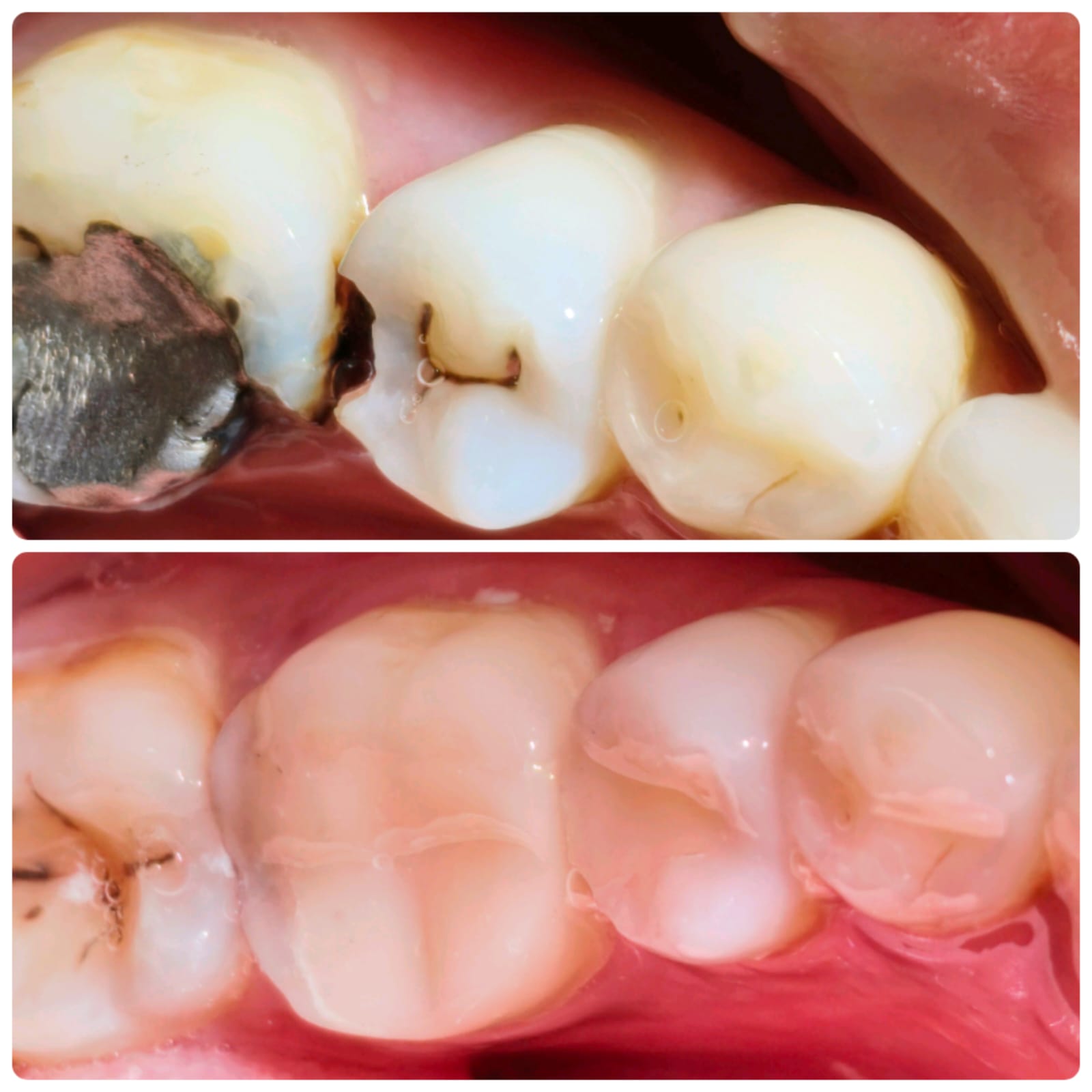food stuck between teeth Vashi case, before and after: old amalgam and proximal cavity restored with composite