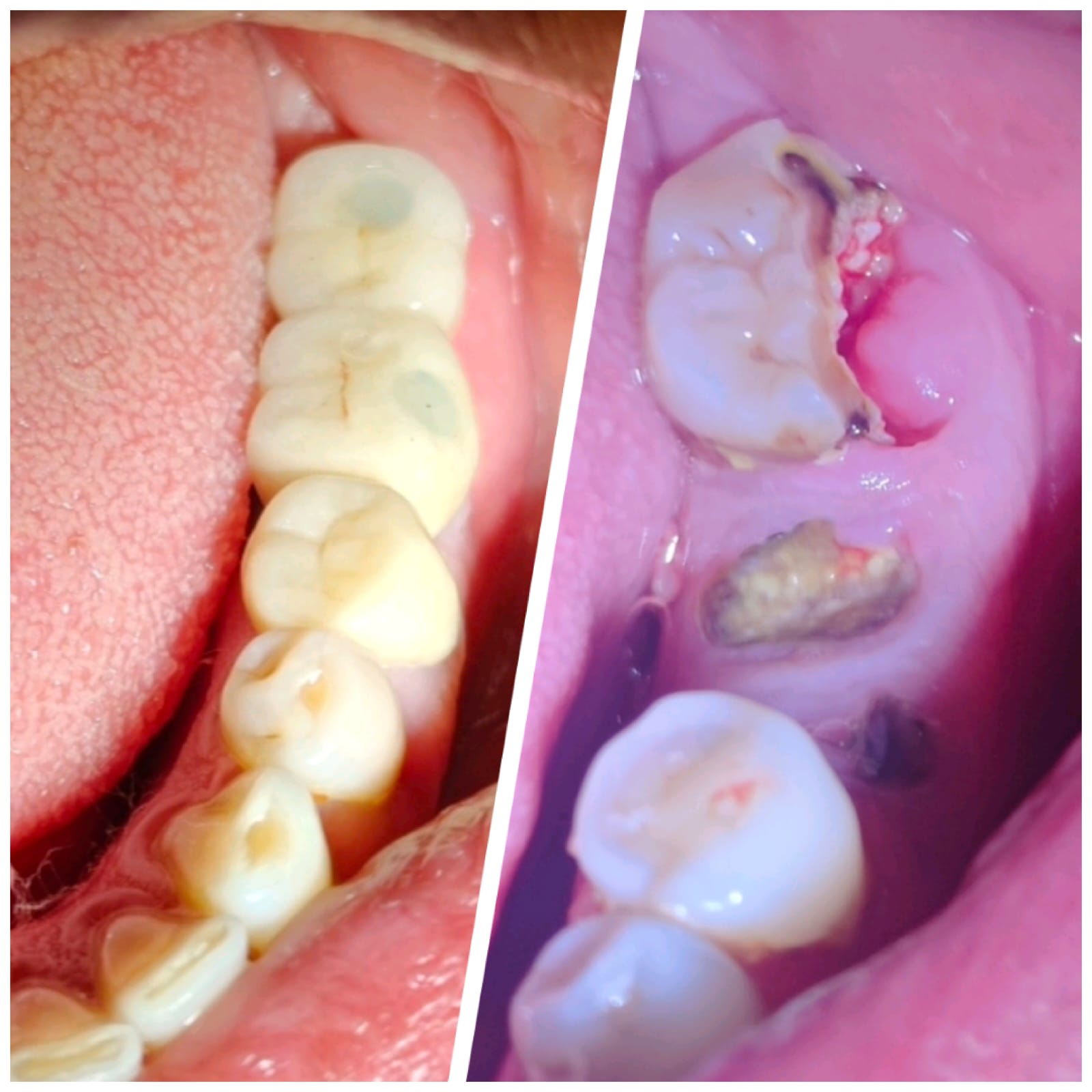 implantologist vashi dental implant case before and after — decayed lower molars restored with implant crowns