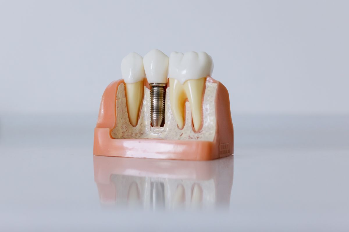 implantologist vashi dental implant model showing implant screw in jawbone beside natural teeth